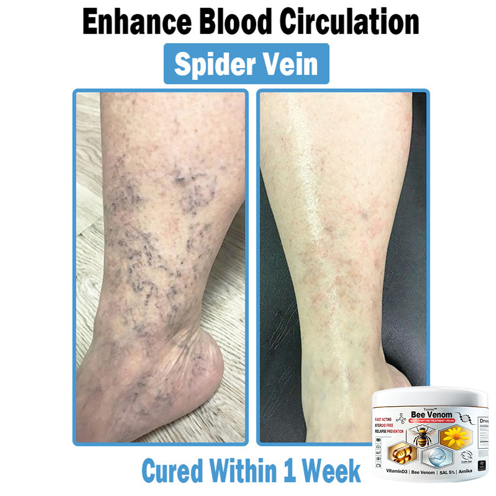 𝐓𝐮𝐫𝐨𝐧𝐮™ 🔥 𝐁𝐞𝐞 𝐕𝐞𝐧𝐨𝐦 𝐌𝐮𝐥𝐭𝐢-𝐒𝐲𝐦𝐩𝐭𝐨𝐦 𝐓𝐫𝐞𝐚𝐭𝐦𝐞𝐧𝐭 𝐂𝐚𝐞𝐚𝐦 (🤩𝐀𝐀𝐃 𝐑𝐞𝐜𝐨𝐦𝐦𝐞𝐧𝐝𝐚𝐭𝐢𝐨𝐧𝐬)🍀