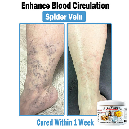 𝐓𝐮𝐫𝐨𝐧𝐮™ 🔥 𝐁𝐞𝐞 𝐕𝐞𝐧𝐨𝐦 𝐌𝐮𝐥𝐭𝐢-𝐒𝐲𝐦𝐩𝐭𝐨𝐦 𝐓𝐫𝐞𝐚𝐭𝐦𝐞𝐧𝐭 𝐂𝐚𝐞𝐚𝐦 (🤩𝐀𝐀𝐃 𝐑𝐞𝐜𝐨𝐦𝐦𝐞𝐧𝐝𝐚𝐭𝐢𝐨𝐧𝐬)🍀