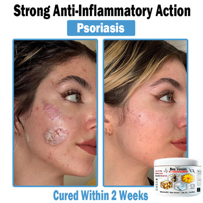 𝐓𝐮𝐫𝐨𝐧𝐮™ 🔥 𝐁𝐞𝐞 𝐕𝐞𝐧𝐨𝐦 𝐌𝐮𝐥𝐭𝐢-𝐒𝐲𝐦𝐩𝐭𝐨𝐦 𝐓𝐫𝐞𝐚𝐭𝐦𝐞𝐧𝐭 𝐂𝐚𝐞𝐚𝐦 (🤩𝐀𝐀𝐃 𝐑𝐞𝐜𝐨𝐦𝐦𝐞𝐧𝐝𝐚𝐭𝐢𝐨𝐧𝐬)🍀