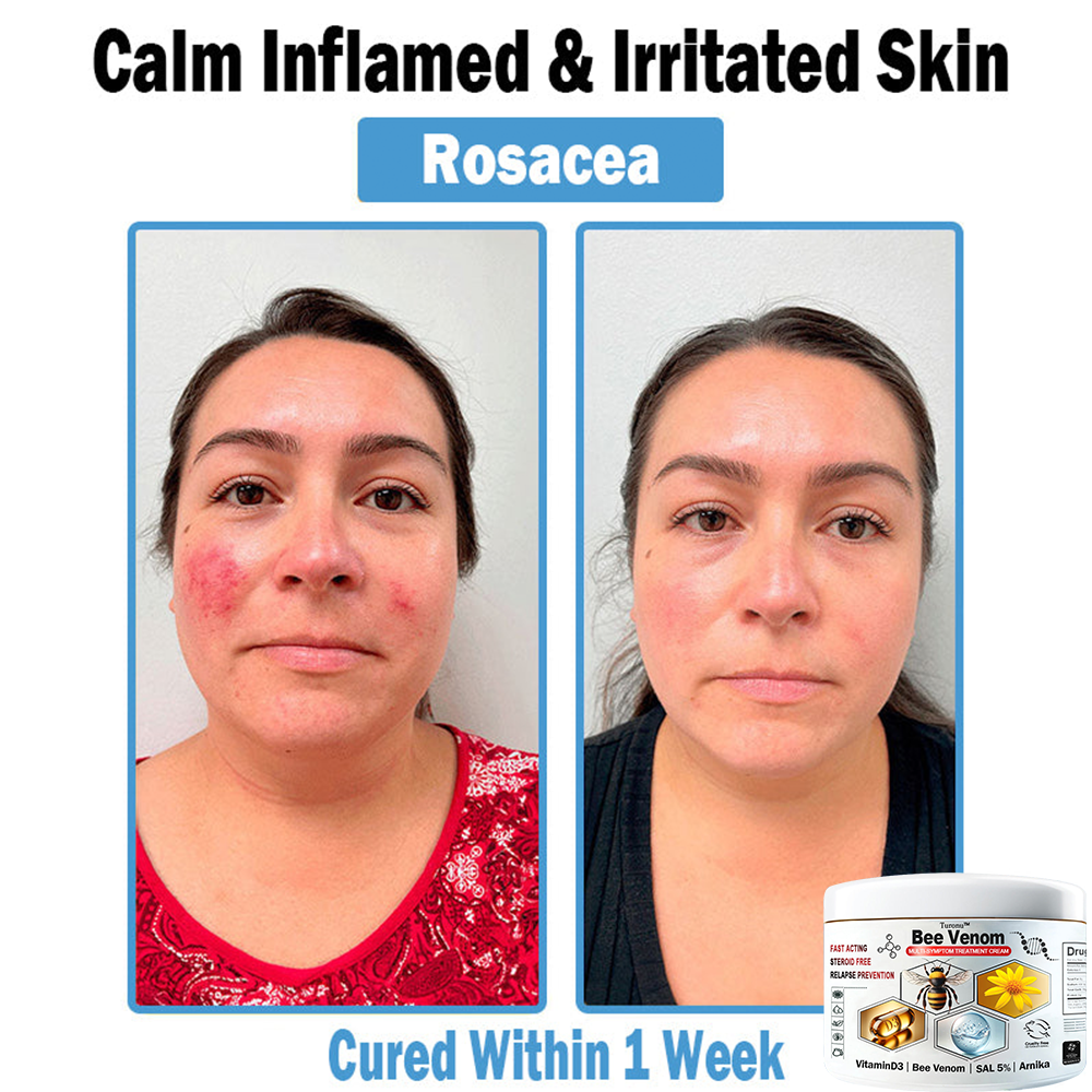 𝐓𝐮𝐫𝐨𝐧𝐮™ 🔥 𝐁𝐞𝐞 𝐕𝐞𝐧𝐨𝐦 𝐌𝐮𝐥𝐭𝐢-𝐒𝐲𝐦𝐩𝐭𝐨𝐦 𝐓𝐫𝐞𝐚𝐭𝐦𝐞𝐧𝐭 𝐂𝐚𝐞𝐚𝐦 (🤩𝐀𝐀𝐃 𝐑𝐞𝐜𝐨𝐦𝐦𝐞𝐧𝐝𝐚𝐭𝐢𝐨𝐧𝐬)🍀